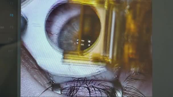 Microkeratome is getting used on the eye in a close up — Stock Video