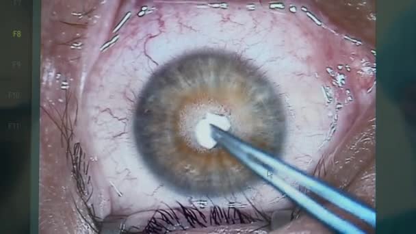 Ameliyat olurken hastaların gözlerini kapat. — Stok video