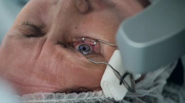 Bir hasta lazer görüşü düzeltiyor.
