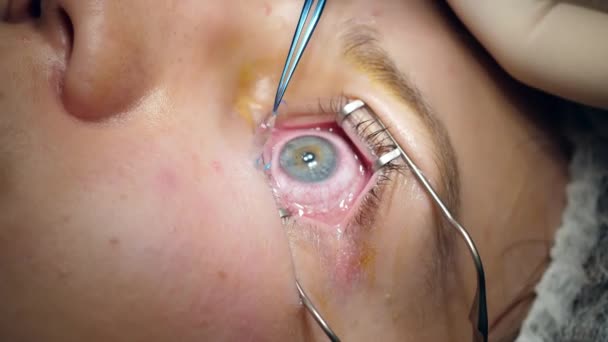 수술중에 환자의 눈에 막 이 맺히고 있습니다 — 비디오