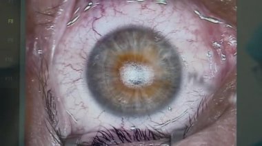 Ameliyat olan bir gözbebeğini kapat.