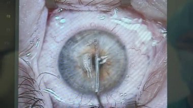 Ameliyat sırasında göz boyunca hareket eden retinayı kapatın.