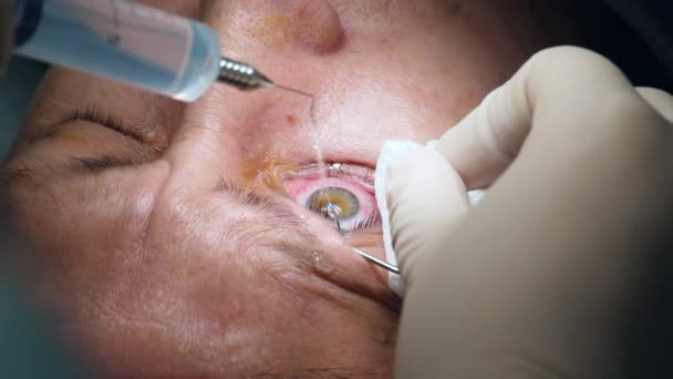 Χειρουργός είναι αναισθησιολόγος ασθενείς μάτι κατά τη διάρκεια της επέμβασης — Αρχείο Βίντεο