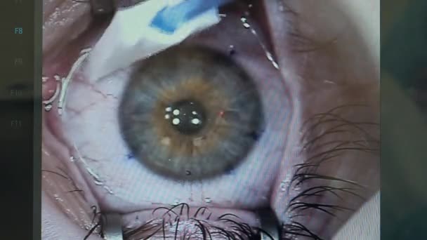 Videobeeld van een oog wordt geveegd tijdens de operatie — Stockvideo