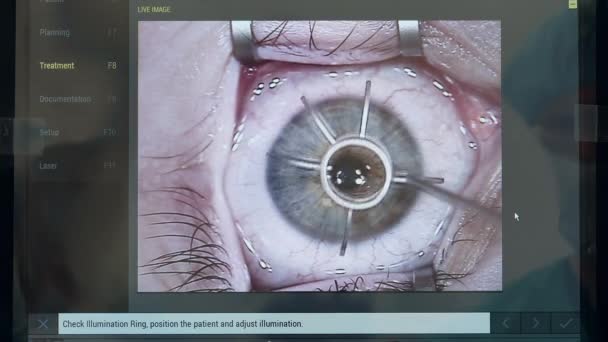 Interfaz de un programa de computadora con la cirugía ocular que se muestra en ella — Vídeo de stock