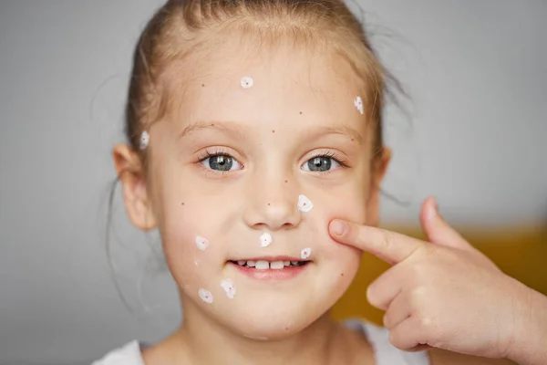 Retrato Uma Menina Sorridente Com Varicela Criança Doente Com Varicela — Fotografia de Stock