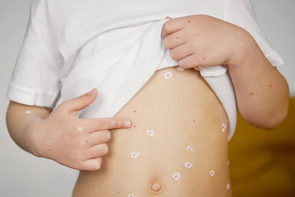 Portrait Smiling Little Child Girl Chicken Pox Sick Toddler Varicella — Stock Photo, Image