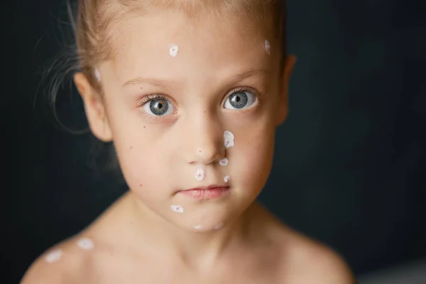 Πορτρέτο Του Χαμογελαστού Κοριτσιού Ανεμοβλογιά Άρρωστο Νήπιο Ανεμευλογιάς Εξάνθημα Φυσαλίδων — Φωτογραφία Αρχείου