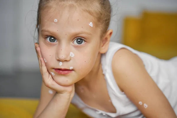 Retrato Uma Criança Com Varicela Criança Doente Com Varicela Vírus — Fotografia de Stock