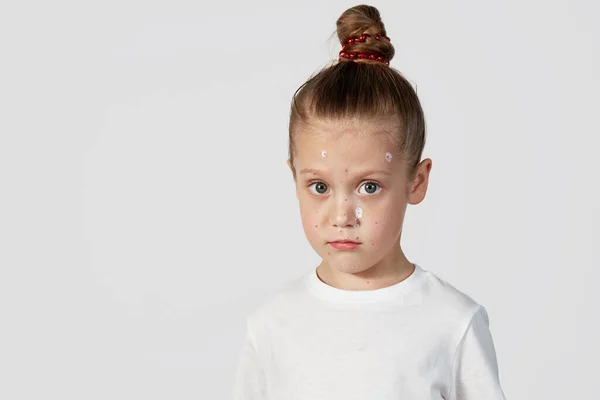 Πορτρέτο Ενός Άρρωστου Κοριτσιού Ανεμοβλογιά Νήπιο Ανεμευλογιάς Εξάνθημα Φυσαλίδων Ανεμοβλογιάς — Φωτογραφία Αρχείου