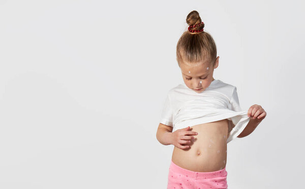 Portrait of a little child girl with chickenpox. Points with a finger at a red pimple on the abdomen. Sick toddler with varicella virus or Chickenpox bubble rash on white background