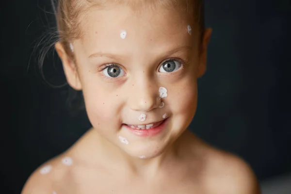 Retrato Uma Criança Com Varicela Criança Doente Com Varicela Vírus — Fotografia de Stock