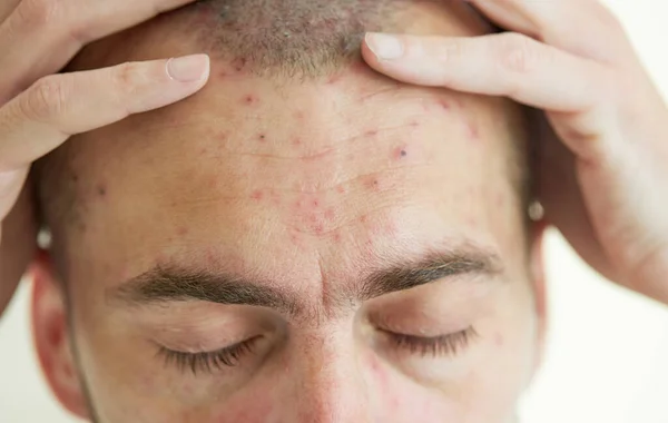 Body Adult Man Have Spotted Red Pimple Bubble Rash Chickenpox — Stock Photo, Image