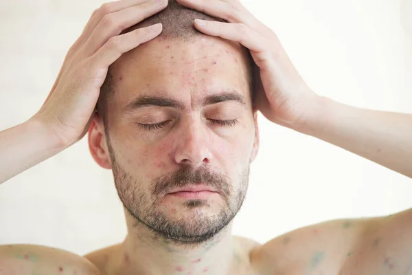 Body Adult Man Have Spotted Red Pimple Bubble Rash Chickenpox — Stock Photo, Image