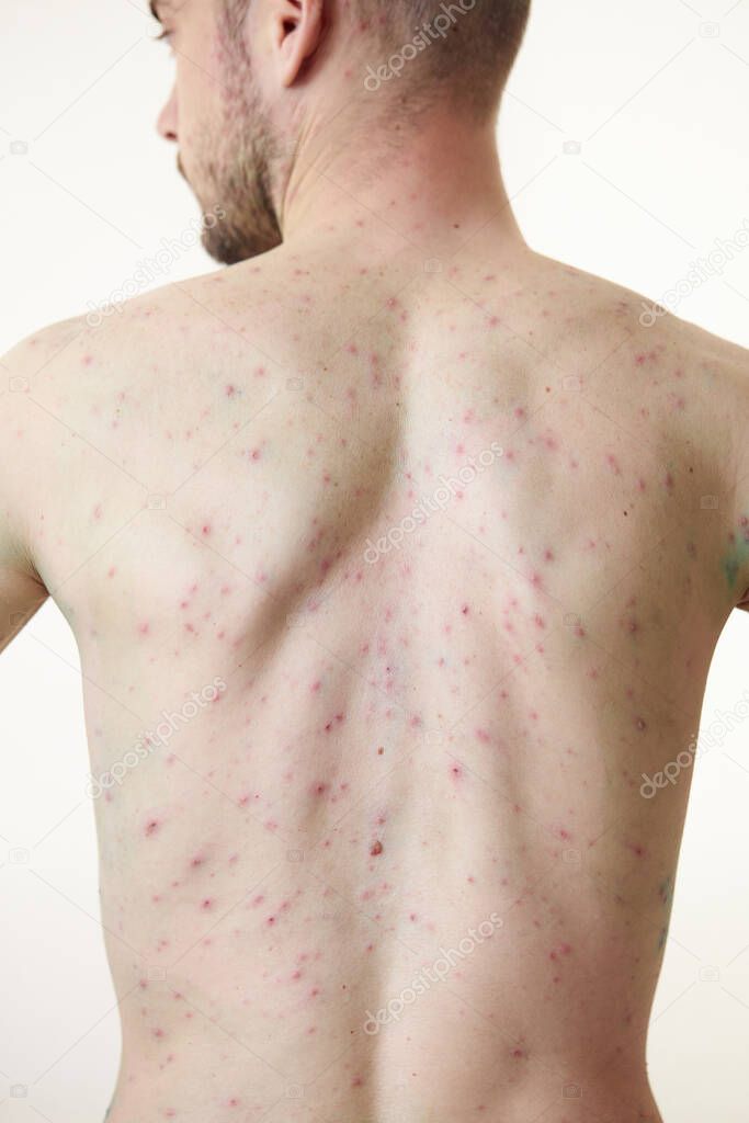 Body of adult  man have spotted, red pimple and bubble rash from chickenpox or varicella zoster virus. Medical complications after illness. Treatment with brilliant green