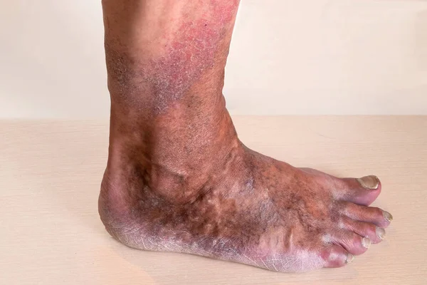 Varicose veins are bulging, sinuous lines that protrude from the skin on the lower leg. However, visible veins are not the only sign that you may have venous disease.