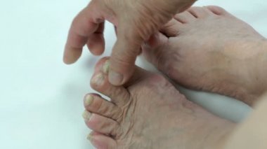 Kişilerin ayak tırnakları üzerinde mantar enfeksiyonu