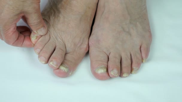 Uñas de los pies de la mujer con infección fúngica — Vídeos de Stock