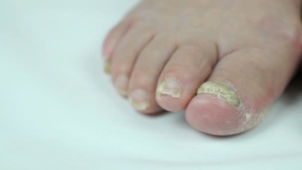 Womans feet has fungal infections of toenails — Stock Video