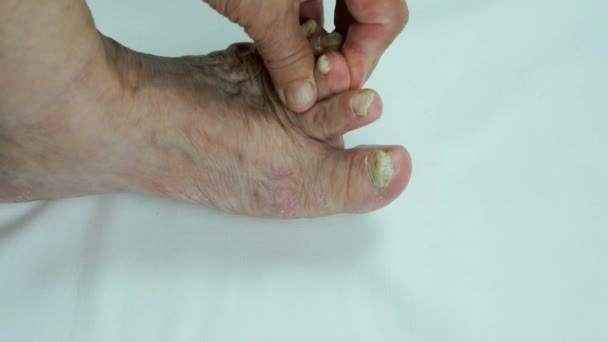 hogyan kell kezelni a gomba lábakat és körmöket a kezelés gomba a körmök vizeletben