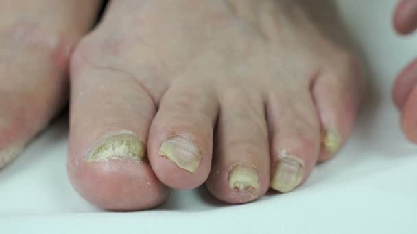 Infección por hongos en las uñas de los pies de las mujeres — Vídeo de stock