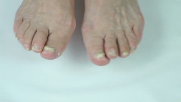 Грибковая инфекция ногтей онихомикоза — стоковое видео