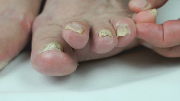 Onicomicosis. La infección fúngica de las uñas de los pies — Vídeos de Stock