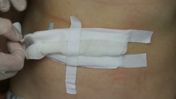 Επίδεσμος. Αφαίρεση γάζας επίδεσμου για τη θεραπεία χειρουργικών ραμμάτων στην παιδική κοιλιά μετά από χειρουργική επέμβαση για ομφαλοκήλη και βουβωνική κήλη. — Αρχείο Βίντεο