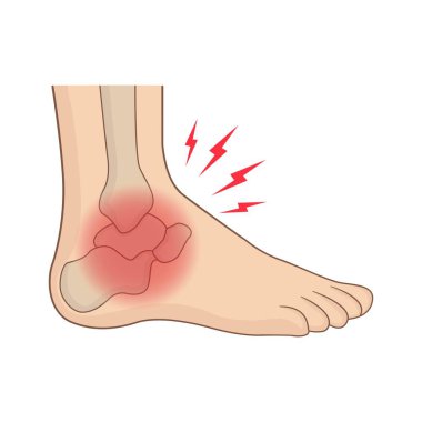 Kırmızı iltihaplı ayak eklemli insan ayağının tıbbi anatomik çizimi