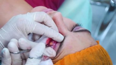 Cerrahlar estetik ameliyat yapar. Göz ameliyatı. Göz kapağından deri parçası alan bir cerrah. Transkonjonktival blefaroplasti..