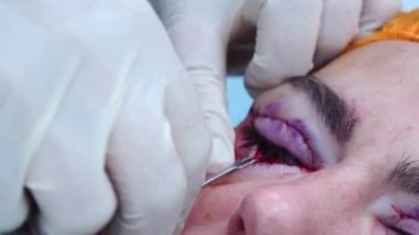 Cerrahların elleri hastaların gözlerindeki kanı siler. Estetik ameliyat. Transkonjonktival blefaroplasti. Göz ameliyatı.