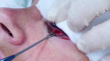 Estetik ameliyat. Göz kapağından yağ parçasını çıkaran bir cerraha yaklaş. Transkonjonktival blefaroplasti. Göz ameliyatı.