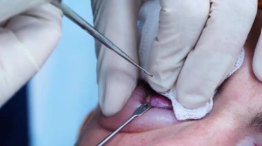 Estetik ameliyat. Cerrahın elleri. Göz kapağından deri parçası alan bir cerrah. Transkonjonktival blefaroplasti. Göz ameliyatı.