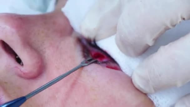 Cirugía plástica. Primer plano de un cirujano extirpando trozo de grasa del párpado. Blefaroplastia transconjuntival. Cirugía ocular. — Vídeo de stock
