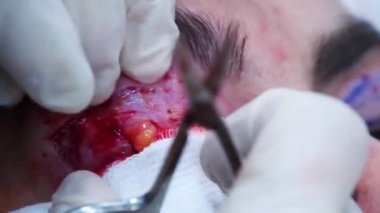 Göz kapağından yağ parçasını çıkaran bir cerraha yaklaş. Estetik ameliyat. Transkonjonktival blefaroplasti. Göz ameliyatı.