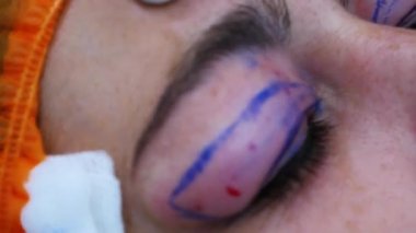 Cerrahın biri gözüne iğne batırır. Cerrahi göz işareti. Estetik ameliyat. Transkonjonktival blefaroplasti. Göz ameliyatı.