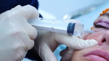 Cerrah hastanın gözüne bir iğne yapar. Estetik ameliyat. Transkonjonktival blefaroplasti. Göz ameliyatı.