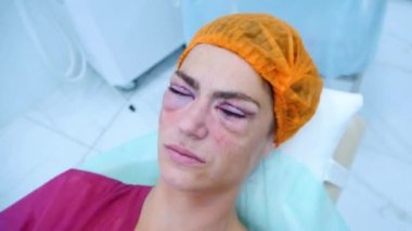 Göz ameliyatından sonra bir hastaya yakın çekim. Ameliyat masasında yatıyor..