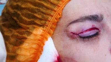 BlePharoplasti. Bir cerrahın yakın çekimi hastaların göz kapaklarını diker. Estetik ameliyat. Göz ameliyatı.