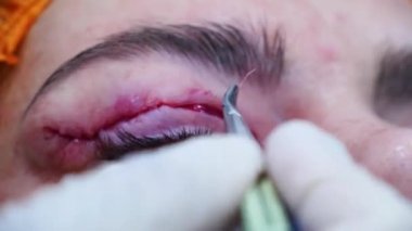 Bir cerrahın yakın çekimi hastaların göz kapaklarını diker. Cerrahi iplik budama. Estetik ameliyat. BlePharoplasti. Göz ameliyatı.