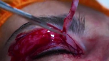 Estetik ameliyata yakın çekim. Göz kapağından deri parçası alan bir cerrah. Transkonjonktival blefaroplasti. Göz ameliyatı.