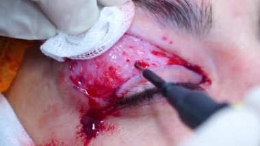 Bir cerrahın yakın çekimi hastaların göz kapaklarını yakar. Cerrahlar estetik ameliyat yapar. Transkonjonktival blefaroplasti. Göz ameliyatı.