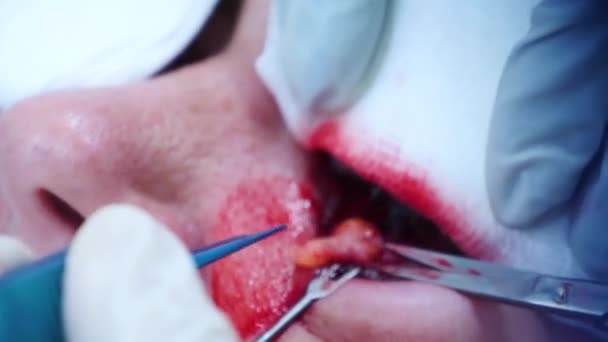 Chirurgia plastyczna. Zbliżenie chirurga usuwającego kawałek tłuszczu z powiek. Transconjunctival blepharoplastyka. Operacja oczu. Chirurgia plastyczna. — Wideo stockowe