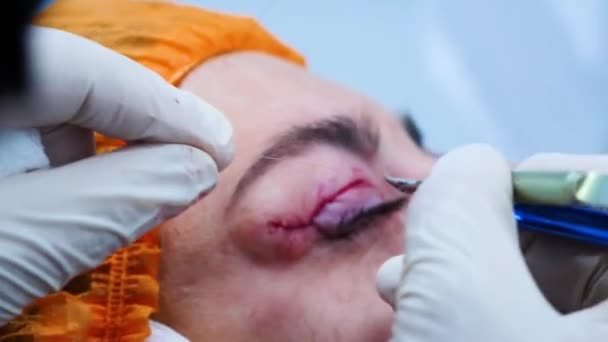 Transkonjunktival blefaroplastik. Närbild av en kirurg suturer patienterna ögonlock. Plastikkirurgi. Ögonkirurgi. — Stockvideo
