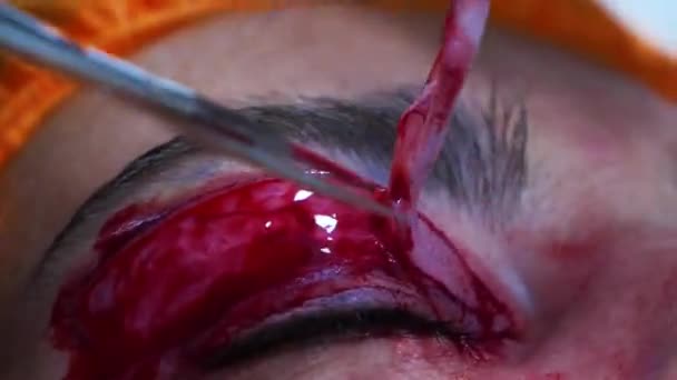 Primer plano de una cirugía plástica. Un cirujano extirpando un pedazo de piel del párpado. Blefaroplastia transconjuntival. Cirugía ocular. — Vídeo de stock