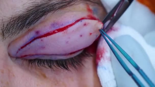 Pendekatan dari operasi plastik. Seorang ahli bedah mengeluarkan sepotong kulit dari kelopak mata. Transconjuncphesblepharoplasty. — Stok Video