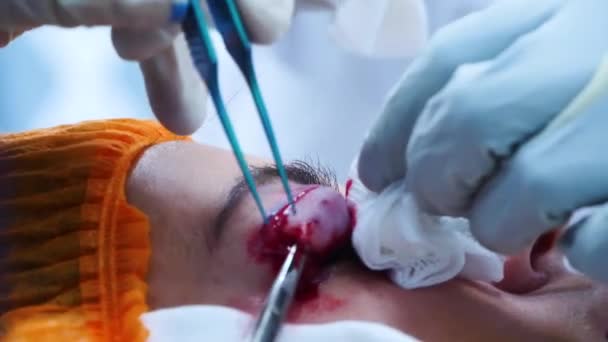 Plasztikai sebészet. Egy sebész eltávolítja a bőrdarabot a szemhéjából. Transzconjunctiva blepharoplasztika. Szemműtét. — Stock videók