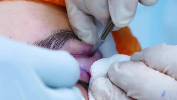 Chirurg doet plastische chirurgie. De chirurg snijdt het ooglid van de patiënt met een scalpel. Transconjunctivale blefaroplastiek. Oogoperatie. — Stockvideo