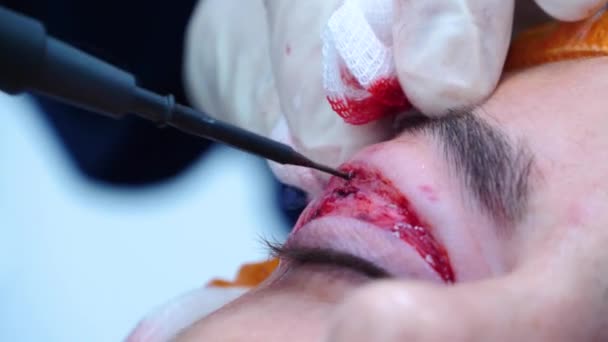 Close-up of a surgeon cauterizes the patients eyelid. Transconjunctival blepharoplasty. Surgeon do plastic surgery. Eye surgery. — Stock Video
