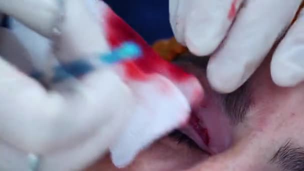 Chirurgul plastician freacă rana cu tampoane de tifon. Chirurgie plastică. blefaroplastie transconjunctivală. Chirurgie ochi . — Videoclip de stoc